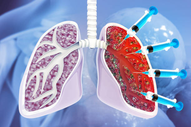 best interstitial lung disease ild treatment in south mumbai