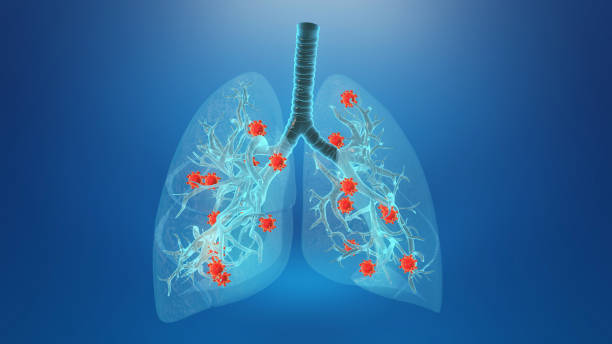 best pulmonary infection specialist in south mumbai