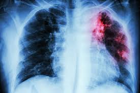 lung fibrosis specialist south mumbai